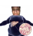 Big fatty liver