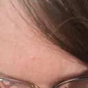 Mia forehead